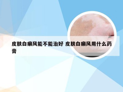 皮肤白癞风能不能治好 皮肤白癞风用什么药膏