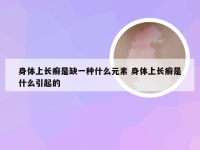 身体上长癣是缺一种什么元素 身体上长癣是什么引起的