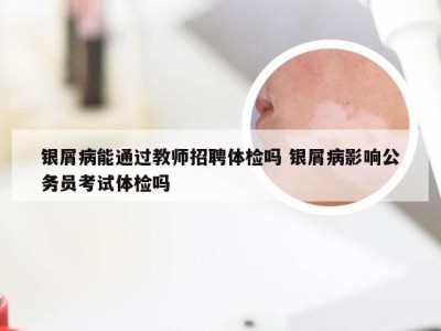 银屑病能通过教师招聘体检吗 银屑病影响公务员考试体检吗