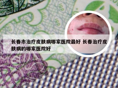 长春市治疗皮肤病哪家医院最好 长春治疗皮肤病的哪家医院好