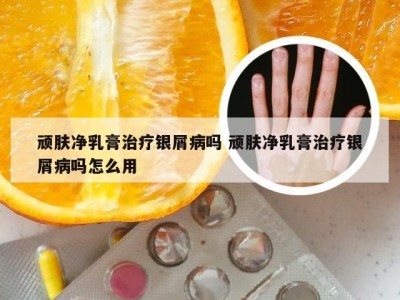 顽肤净乳膏治疗银屑病吗 顽肤净乳膏治疗银屑病吗怎么用