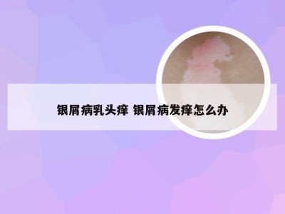 银屑病乳头痒 银屑病发痒怎么办