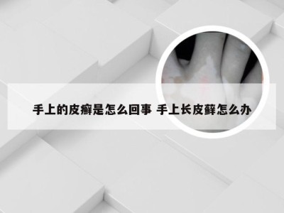 手上的皮癣是怎么回事 手上长皮藓怎么办