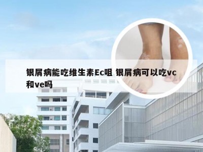 银屑病能吃维生素Ec咀 银屑病可以吃vc和ve吗