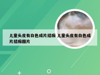 儿童头皮有白色成片结痂 儿童头皮有白色成片结痂图片