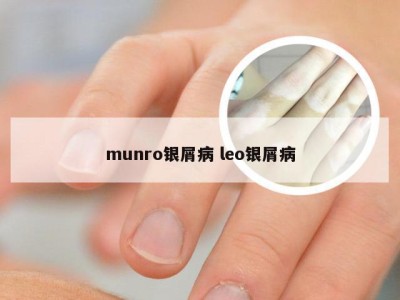 munro银屑病 leo银屑病