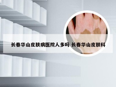 长春华山皮肤病医院人多吗 长春华山皮肤科