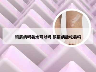 银屑病喝姜水可以吗 银屑病能吃姜吗