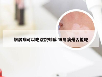 银屑病可以吃跳跳蛙嘛 银屑病是否能吃