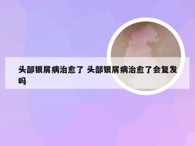 头部银屑病治愈了 头部银屑病治愈了会复发吗