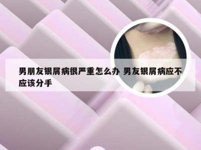 男朋友银屑病很严重怎么办 男友银屑病应不应该分手