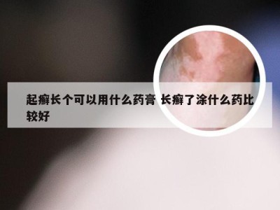 起癣长个可以用什么药膏 长癣了涂什么药比较好