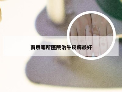 南京哪所医院治牛皮癣最好