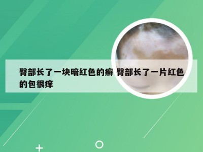 臀部长了一块暗红色的癣 臀部长了一片红色的包很痒