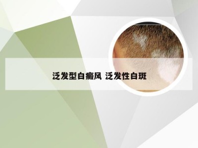 泛发型白癜风 泛发性白斑