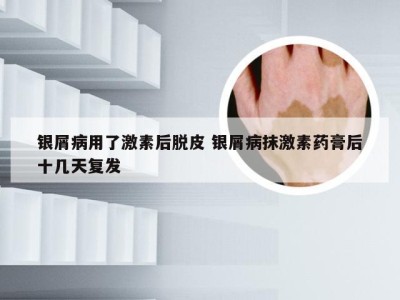 银屑病用了激素后脱皮 银屑病抹激素药膏后十几天复发