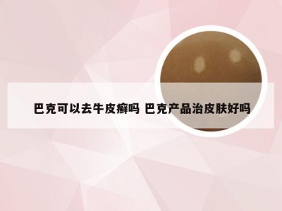 巴克可以去牛皮癣吗 巴克产品治皮肤好吗