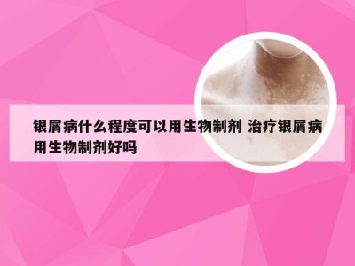 银屑病什么程度可以用生物制剂 治疗银屑病用生物制剂好吗