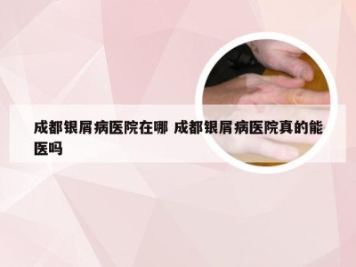 成都银屑病医院在哪 成都银屑病医院真的能医吗