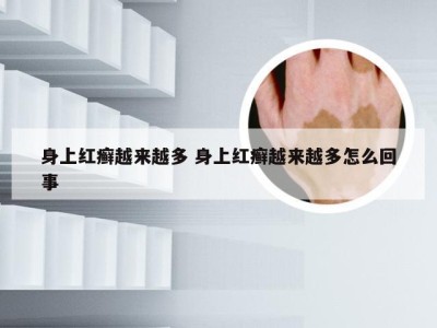 身上红癣越来越多 身上红癣越来越多怎么回事