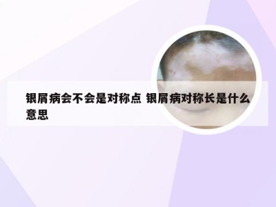 银屑病会不会是对称点 银屑病对称长是什么意思