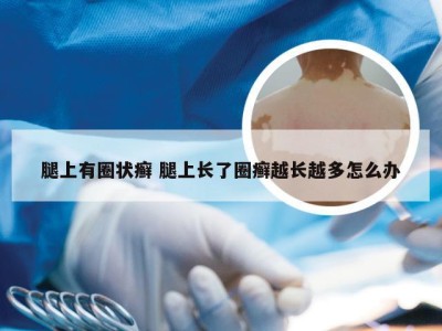 腿上有圈状癣 腿上长了圈癣越长越多怎么办