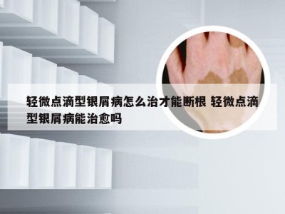 轻微点滴型银屑病怎么治才能断根 轻微点滴型银屑病能治愈吗