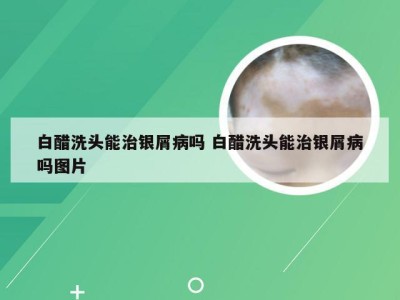 白醋洗头能治银屑病吗 白醋洗头能治银屑病吗图片