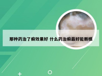 那种药治了癣效果好 什么药治癣最好能断根