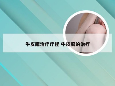 牛皮廨治疗疗程 牛皮廨的治疗