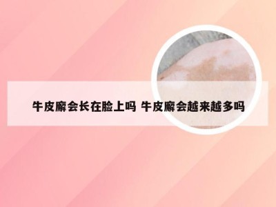 牛皮廨会长在脸上吗 牛皮廨会越来越多吗