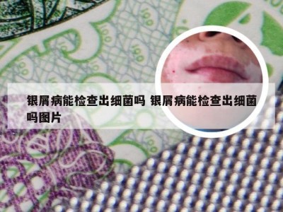 银屑病能检查出细菌吗 银屑病能检查出细菌吗图片