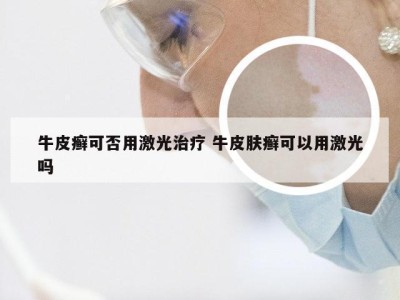 牛皮癣可否用激光治疗 牛皮肤癣可以用激光吗