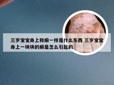 三岁宝宝身上和癣一样是什么东西 三岁宝宝身上一块块的癣是怎么引起的