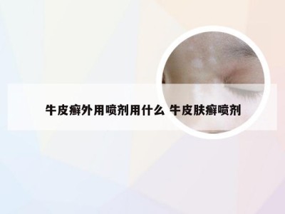 牛皮癣外用喷剂用什么 牛皮肤癣喷剂