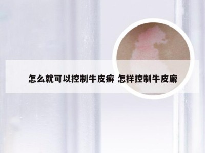 怎么就可以控制牛皮癣 怎样控制牛皮廨