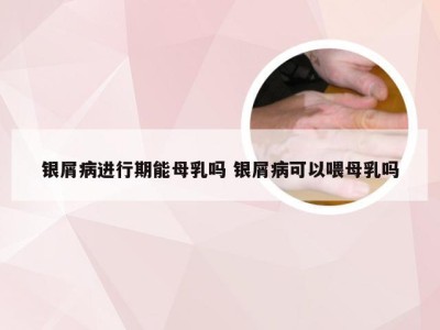 银屑病进行期能母乳吗 银屑病可以喂母乳吗