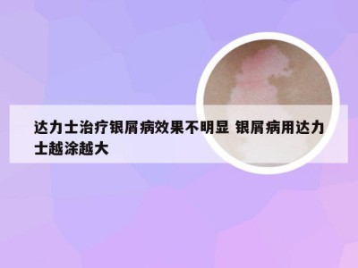 达力士治疗银屑病效果不明显 银屑病用达力士越涂越大