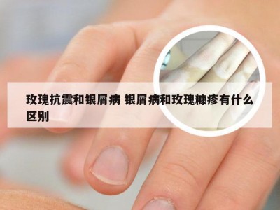 玫瑰抗震和银屑病 银屑病和玫瑰糠疹有什么区别