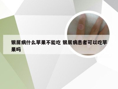 银屑病什么苹果不能吃 银屑病患者可以吃苹果吗