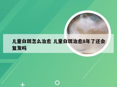 儿童白斑怎么治愈 儿童白斑治愈8年了还会复发吗