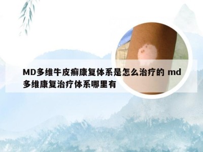 MD多维牛皮癣康复体系是怎么治疗的 md多维康复治疗体系哪里有