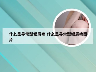 什么是寻常型银屑病 什么是寻常型银屑病图片