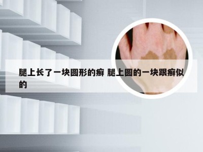 腿上长了一块圆形的癣 腿上圆的一块跟癣似的