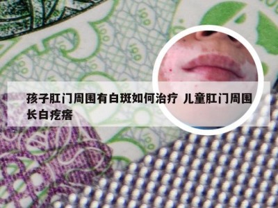 孩子肛门周围有白斑如何治疗 儿童肛门周围长白疙瘩