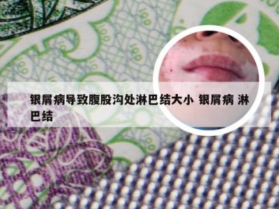 银屑病导致腹股沟处淋巴结大小 银屑病 淋巴结