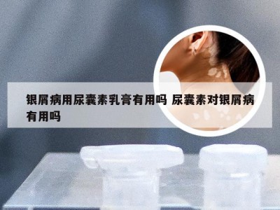 银屑病用尿囊素乳膏有用吗 尿囊素对银屑病有用吗