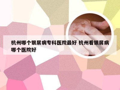 杭州哪个银屑病专科医院最好 杭州看银屑病哪个医院好