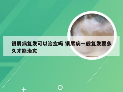 银屑病复发可以治愈吗 银屑病一般复发要多久才能治愈