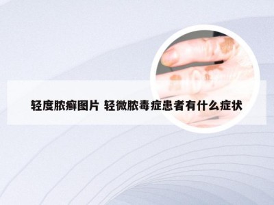 轻度脓癣图片 轻微脓毒症患者有什么症状